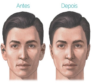 Otoplastia